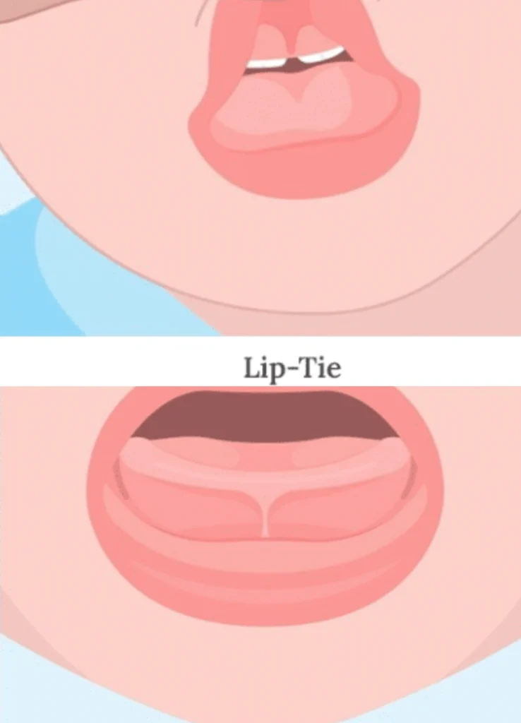 Lip Tie Baby